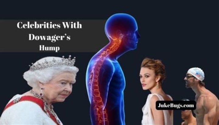 Celebrities And The Hidden Battle With Dowager's Hump
